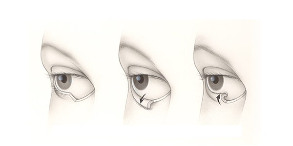 Post operative lasik care